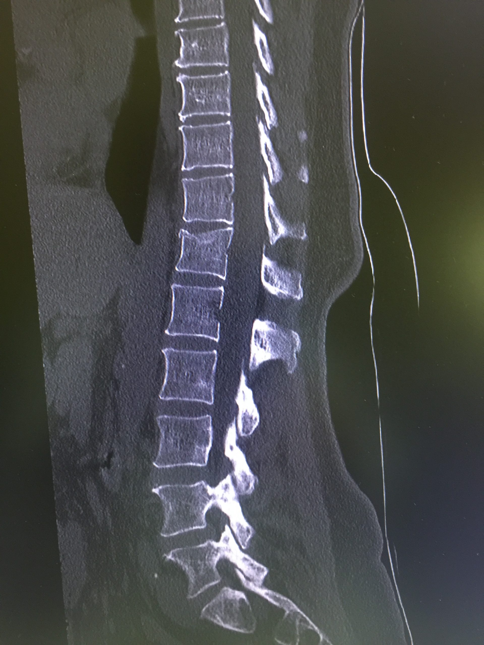 Wirbelkörperbruch bei Osteoporose TH12